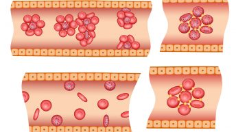 Infected blood cells